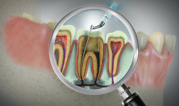 How Root Canal Therapy Helps Protect Your Natural Teeth in LA