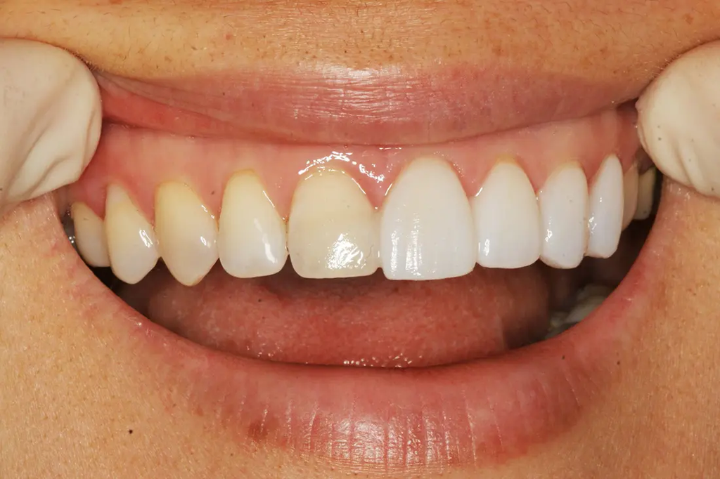 traditional veneers