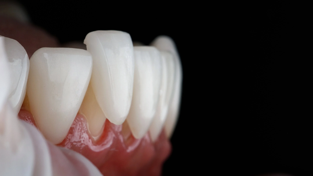 porcelain veneers