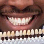 dental veneers