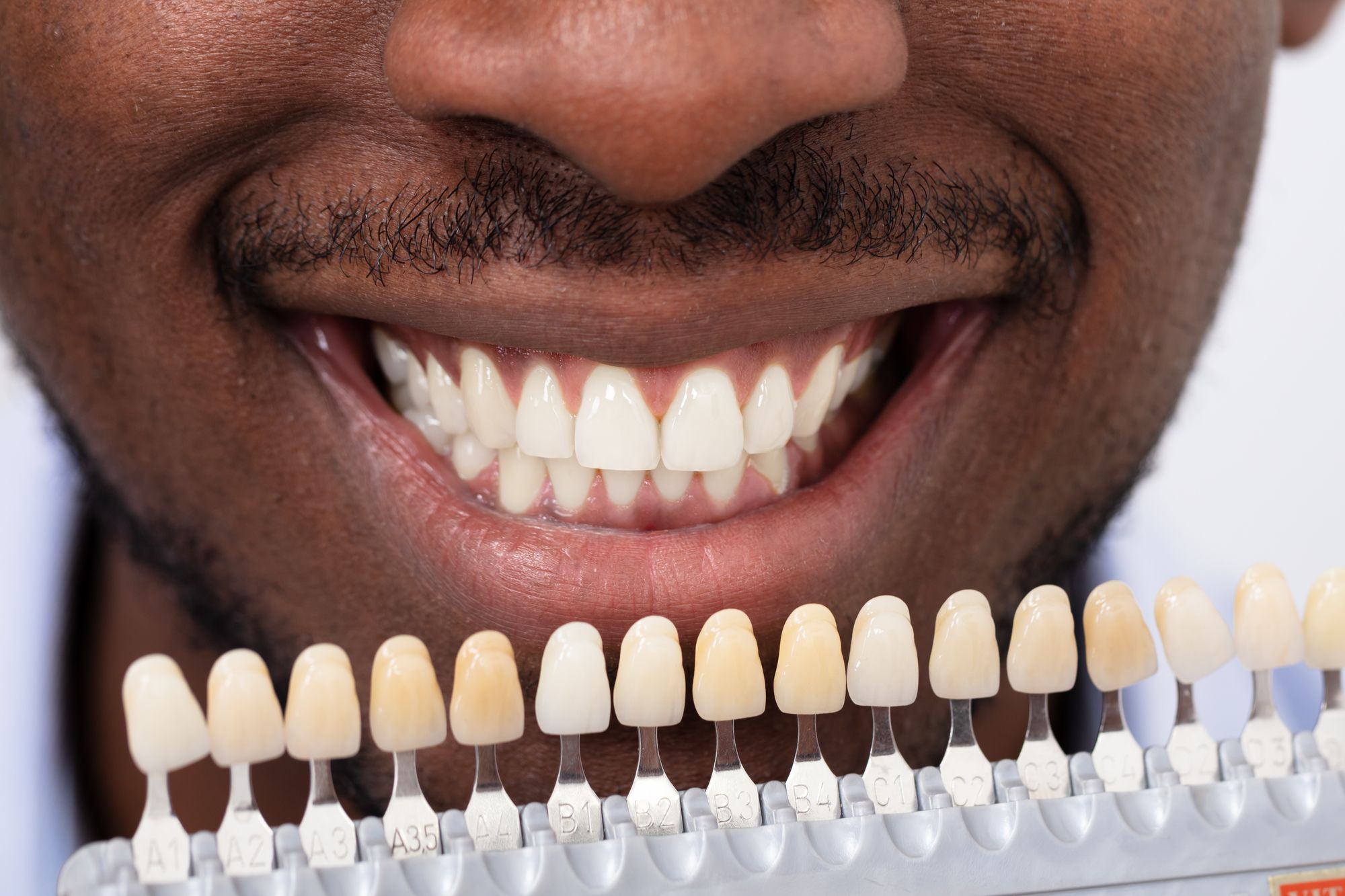 Are No-Prep Veneers in Agoura Hills Right for Your Smile?