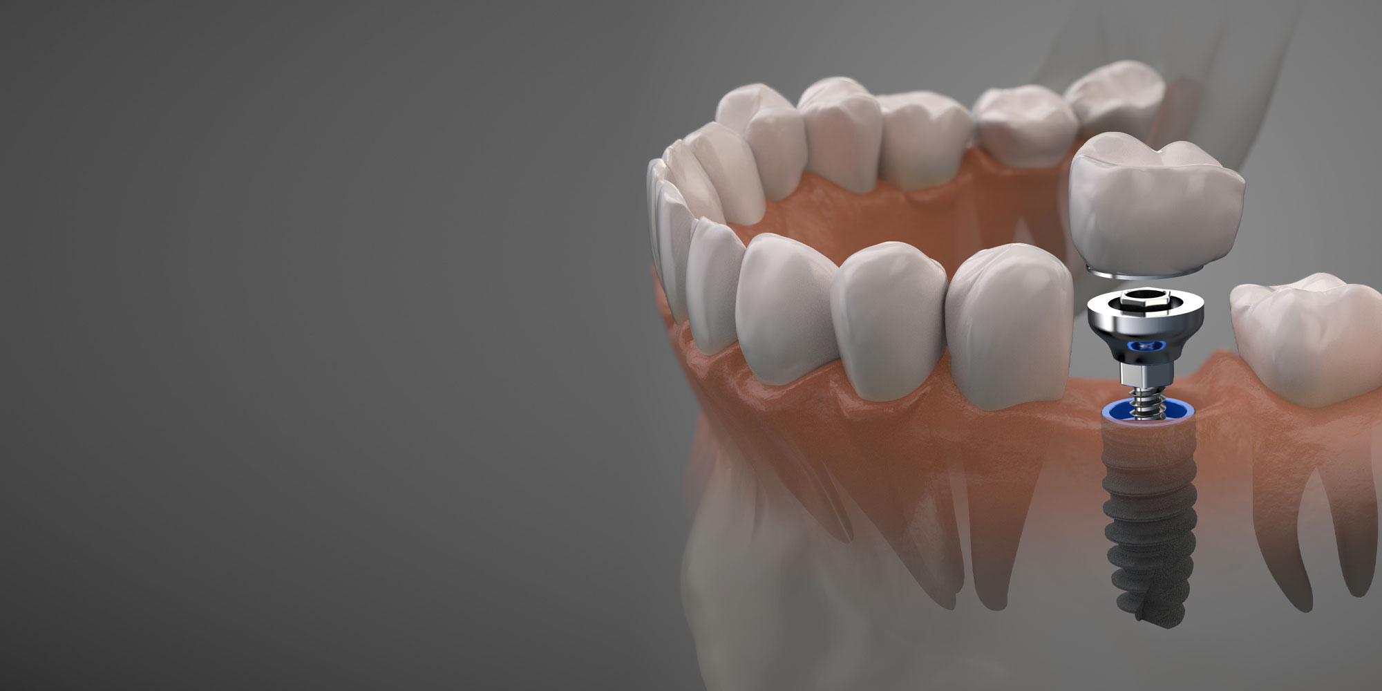Does a Missing Back Tooth Need an Implant If You Can Still Chew?