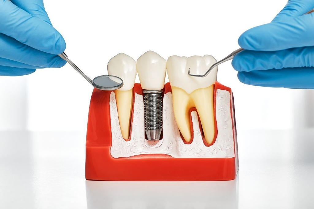 Dental implants in Agoura Hills